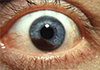 Uveal Melanoma in the eye