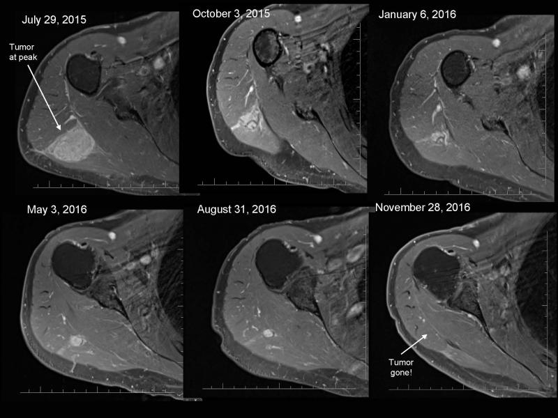 MRI Shoulder Comparison November 2016 David Rohler