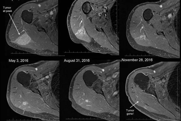 MRI Shoulder Comparison November 2016 David Rohler